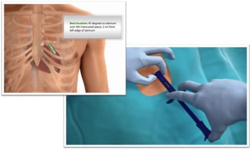 Al Fatebenefratelli impiantato dispositivo miniaturizzato in grado di rilevare aritmie cardiache